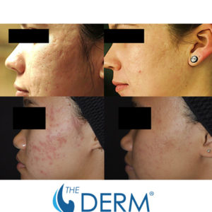 Before-and-after-fractional Before-and-after-fractional
