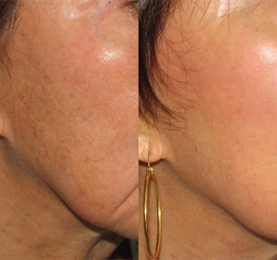 dermaplaningBnA dermaplaningBnA