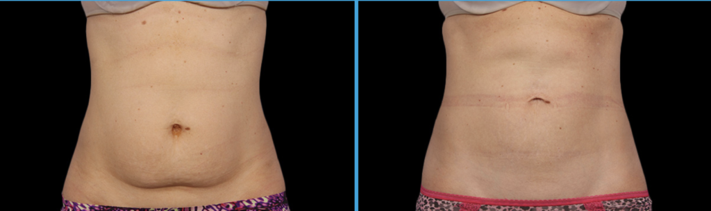 coolsculpting fat freeze
