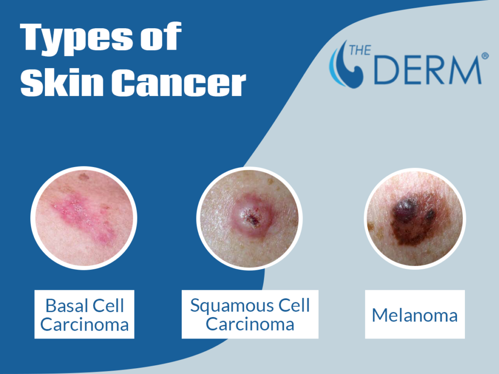 types of skin cancer