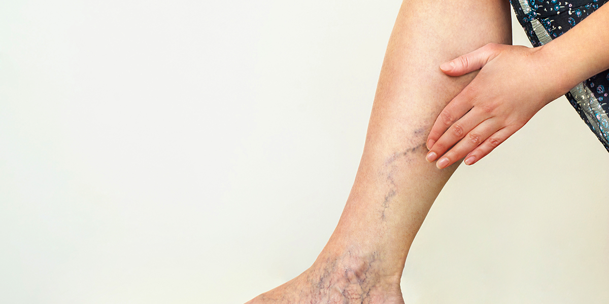 skipping for varicose veins