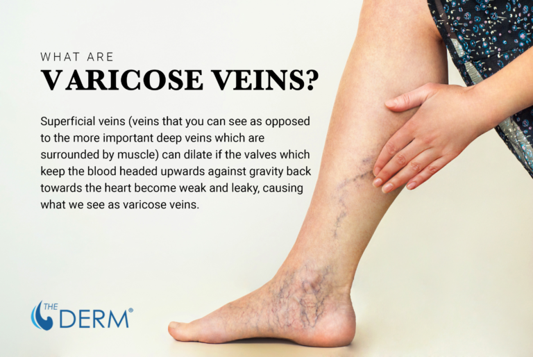 Varicose Veins What’s The Deal And How To Heal The Derm Dermatologists In Cook County Il