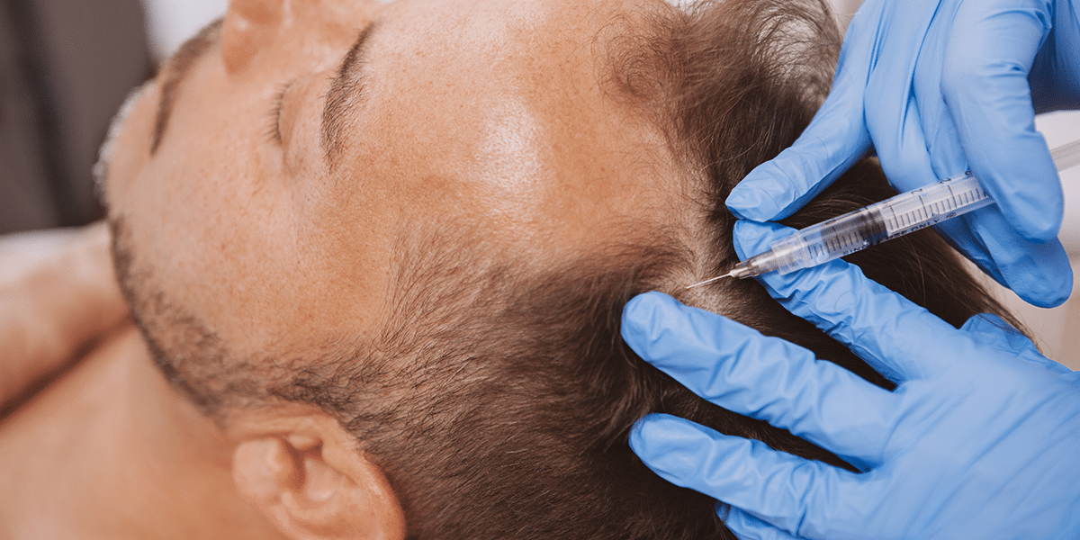PRP For Hair Loss: How to Treat Hair Loss Long-Term - The Derm |  Dermatologists in Cook County, IL