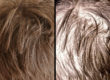 Hair loss