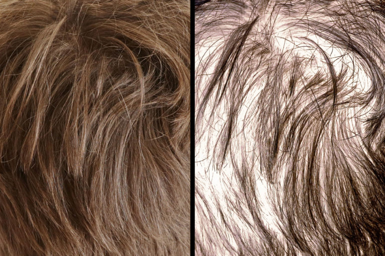 Hair loss