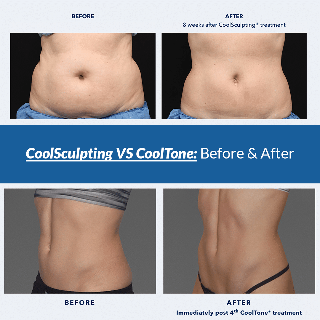 coolsculpting vs cooltone before and after