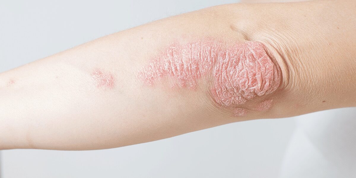 psoriasis psoriasis
