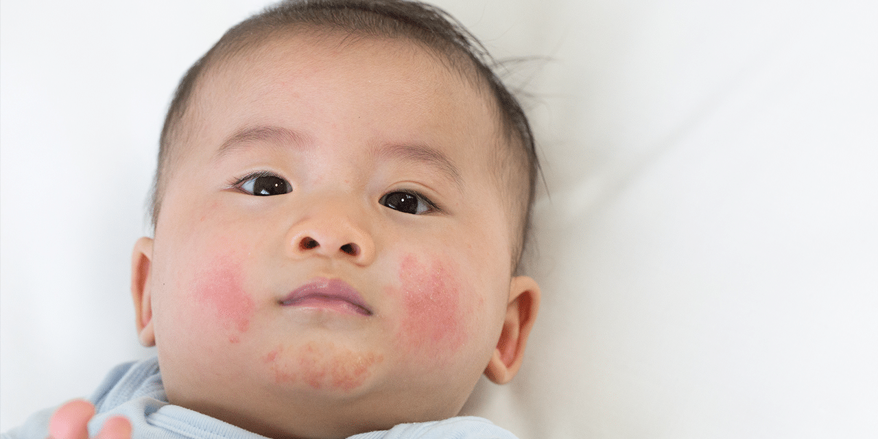 eczema in kids