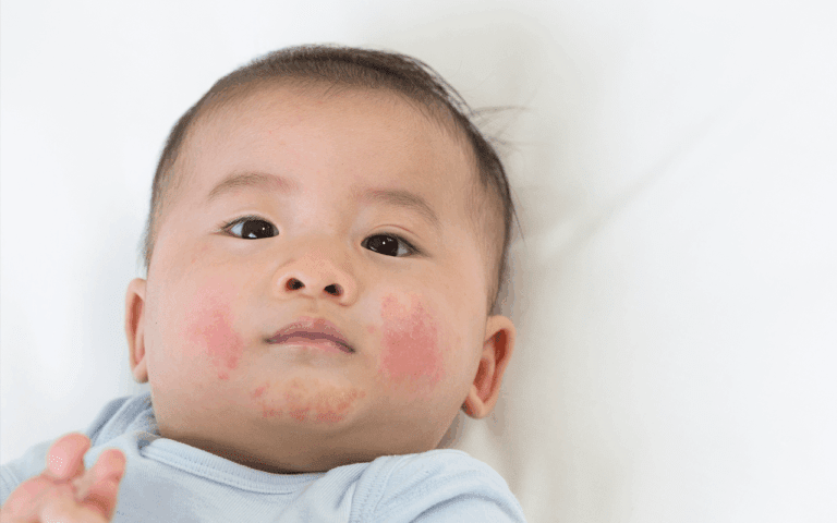 eczema in kids