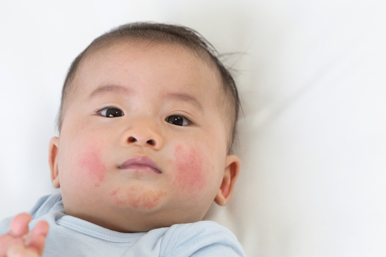 eczema in kids eczema in kids