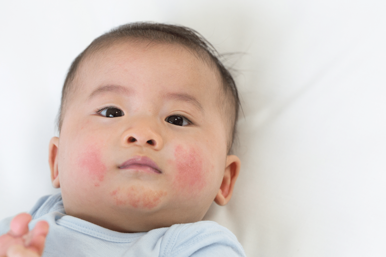 eczema in kids