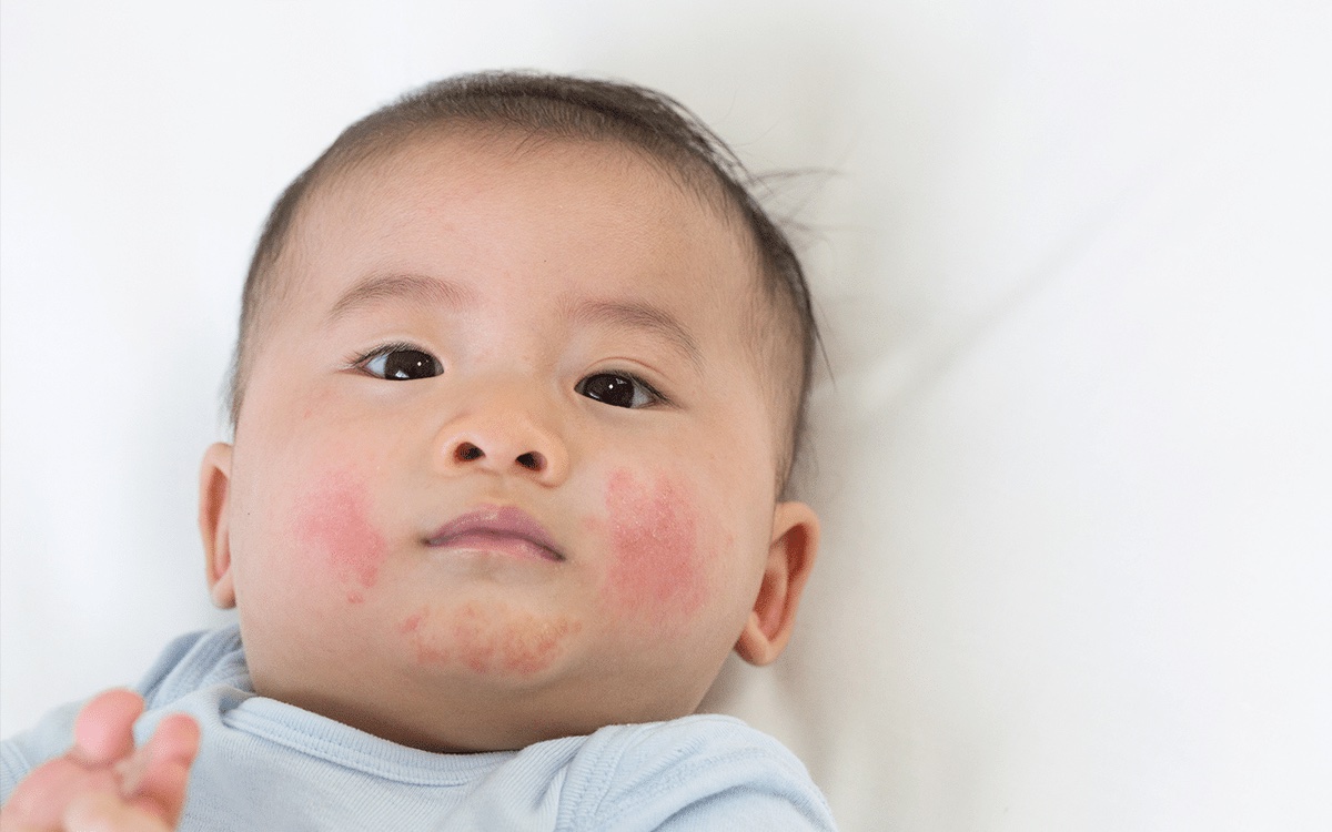 eczema in kids