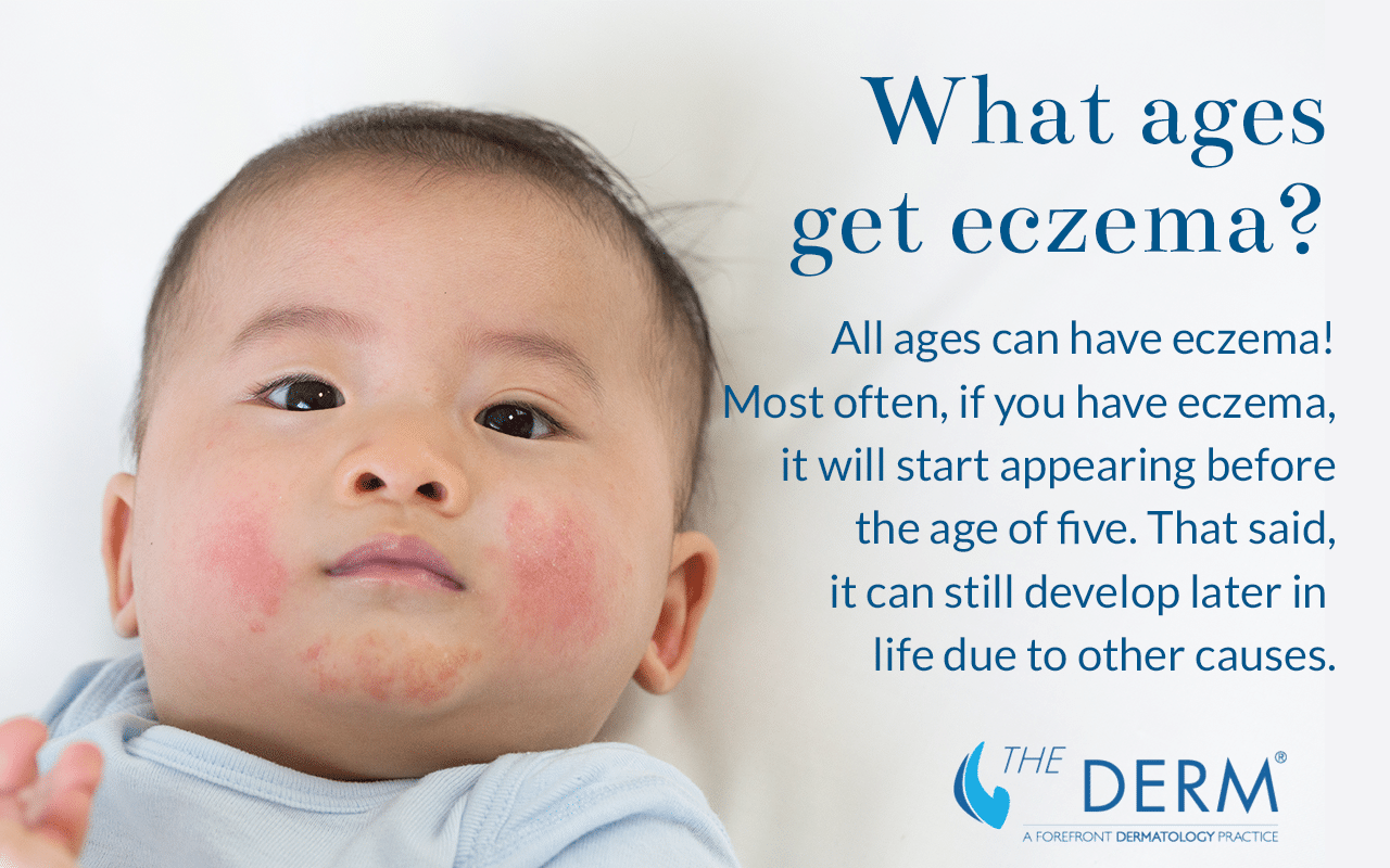 what ages get eczema