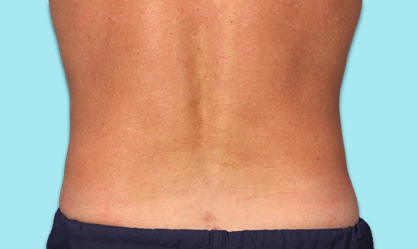 CoolSculpting Flanks (Love Handles) Before & After Photos - Cosmetic -  Ark-La-Tex Dermatology & Medical Spa - Louisiana - A Part of the  Willis-Knighton Physician Network