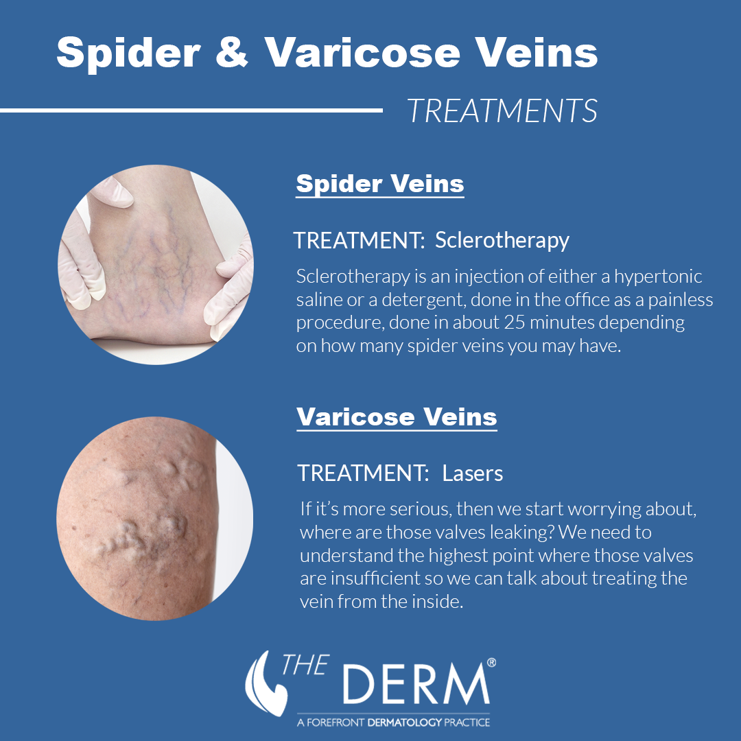 fusionere performer Nominering How to Treat Spider Veins for Long-Term Results