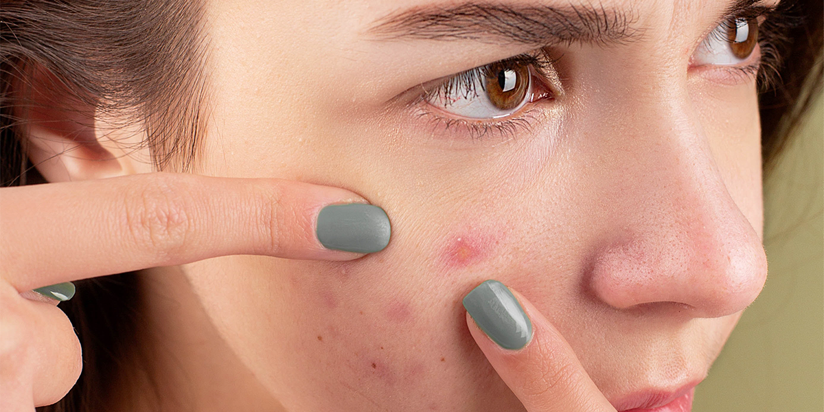 all about acne