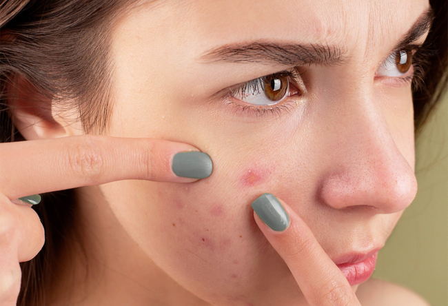 all about acne