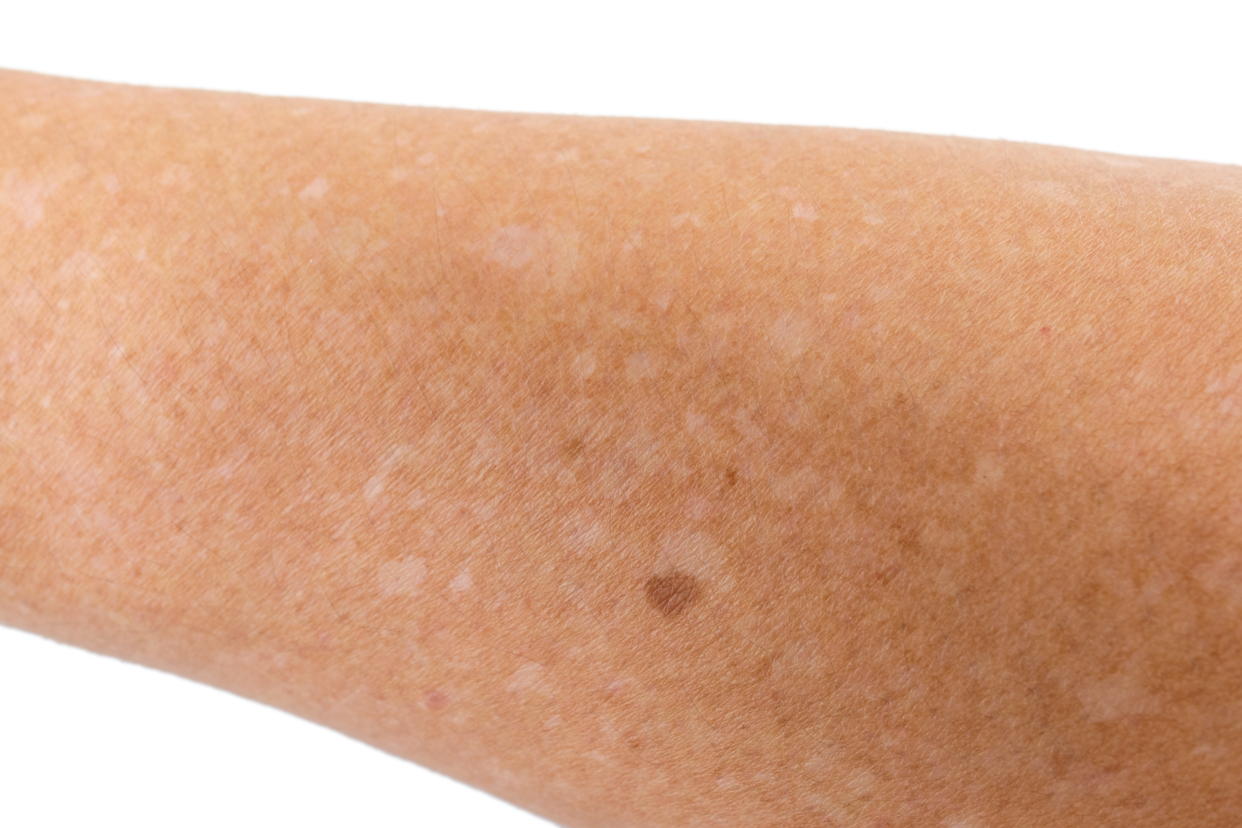 Which Vitamin Deficiency Causes White Spots on Skin? - The Derm |  Dermatologists in Cook County, IL
