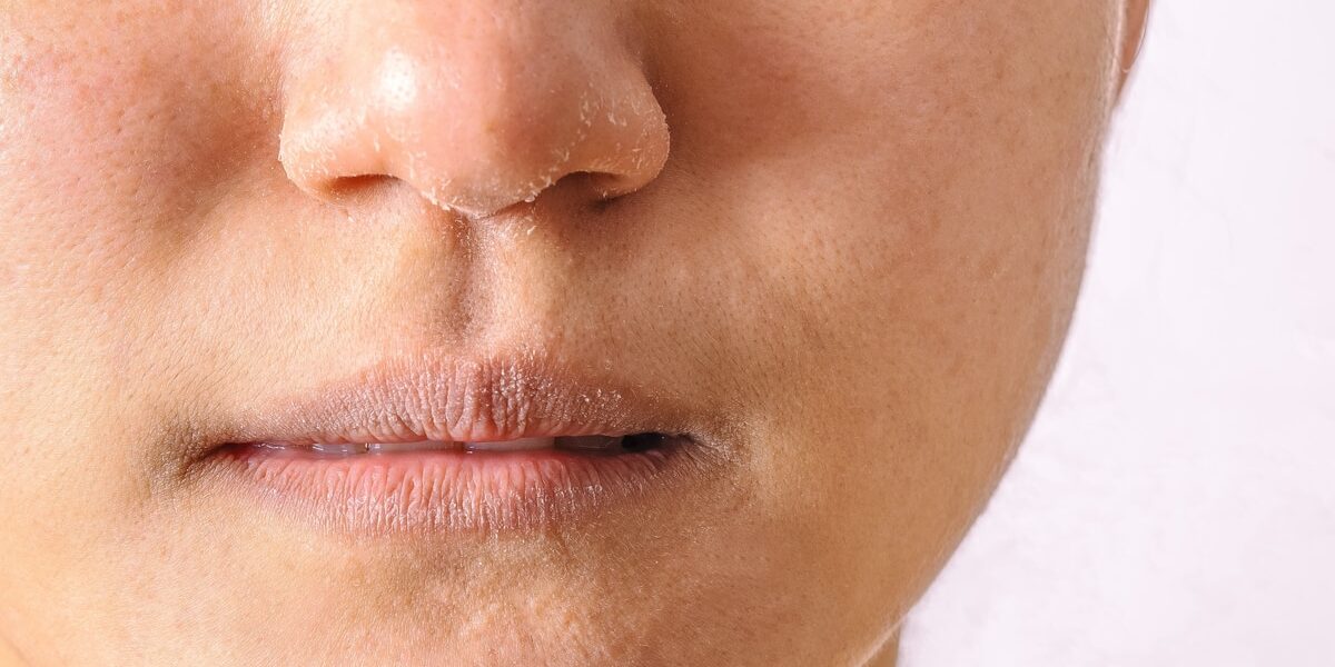 Allergic women have eczema dry nose and lips on winter season closeup. Allergic women have eczema dry nose and lips on winter season closeup.