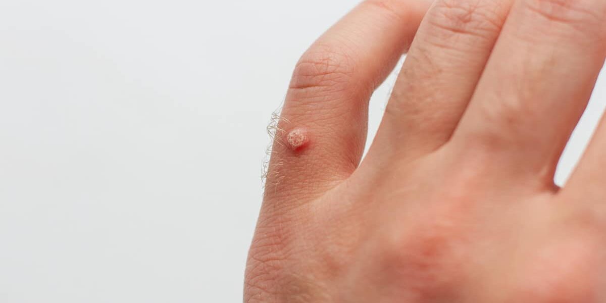 wart on hand, skin problem