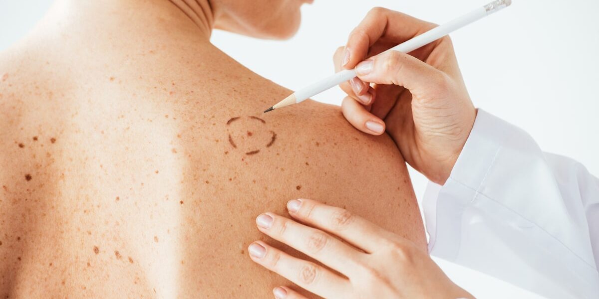 cropped view of dermatologist applying marks on skin of naked woman with melanoma isolated on white