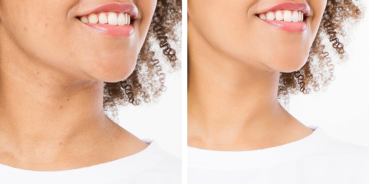 Before and after close-up of woman's face showing acne treatment results