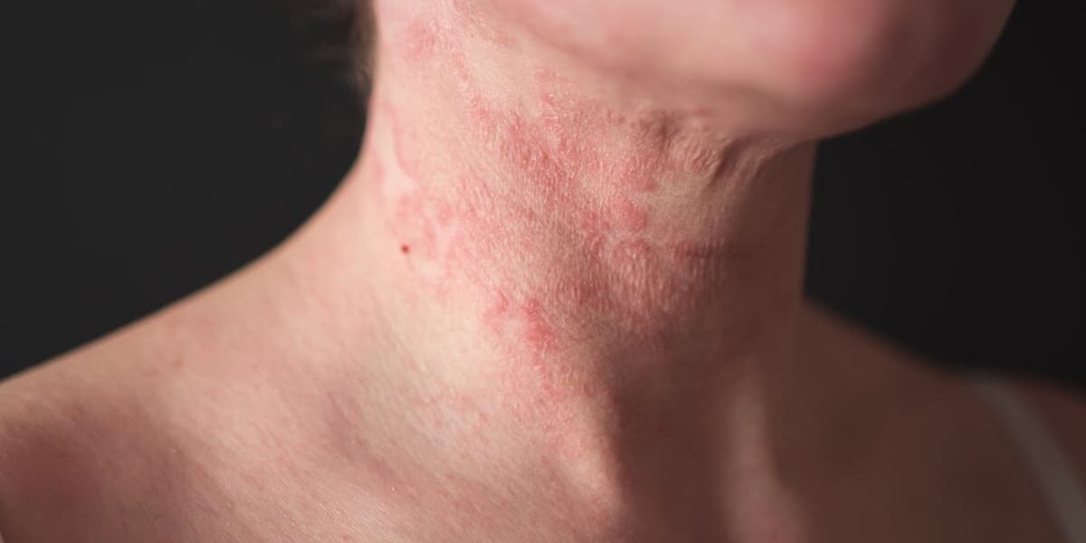 the girl has dermatitis on the neck on a black background