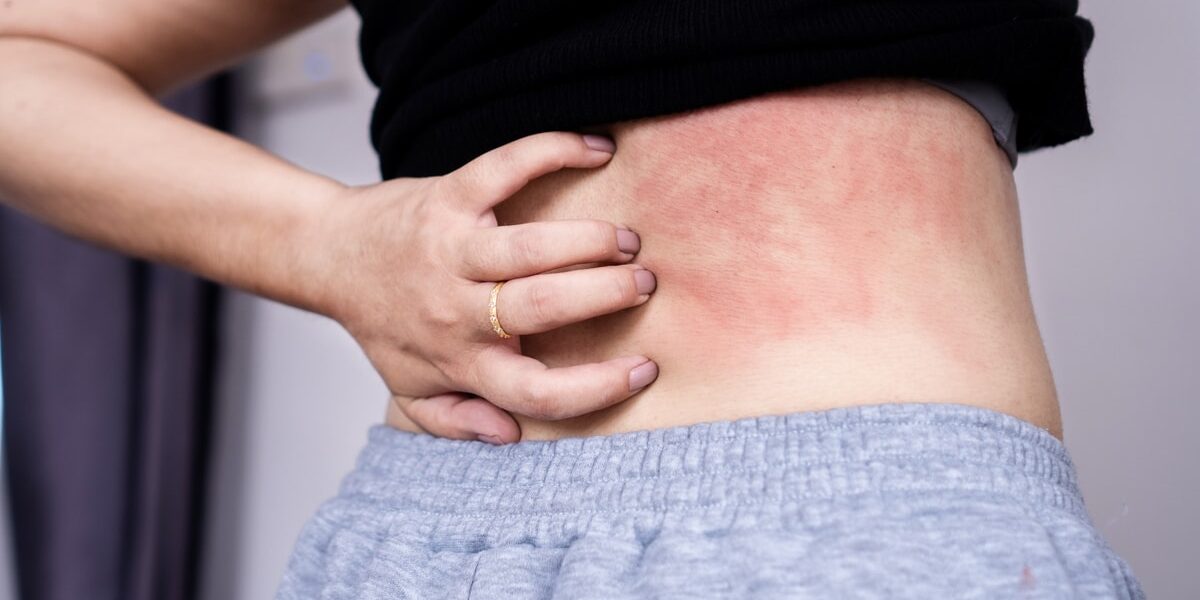 woman suffering from skin disease hand scratching on her itchy back due to allergy to sweat Woman scratching itchy skin rash on her back due to allergy