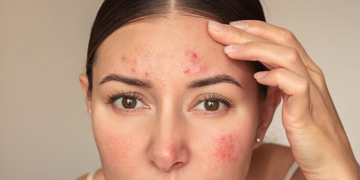 Young caucasian woman looking at camera and examines pimples on her forehead. Young caucasian woman looking at camera