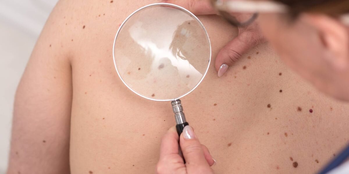 Dermatologist examining the skin on the back of a patient