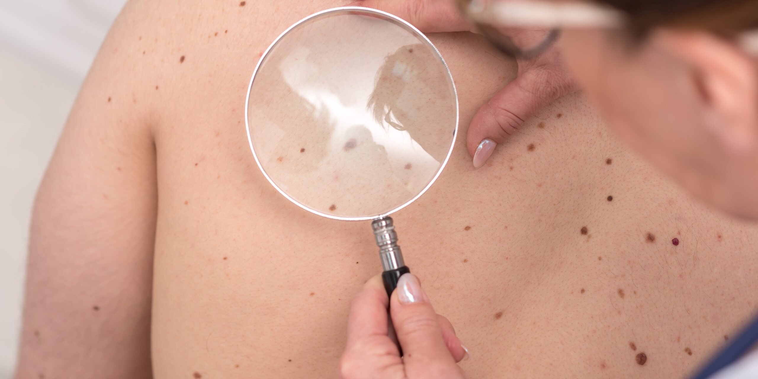 Dermatologist examining the skin of a patient