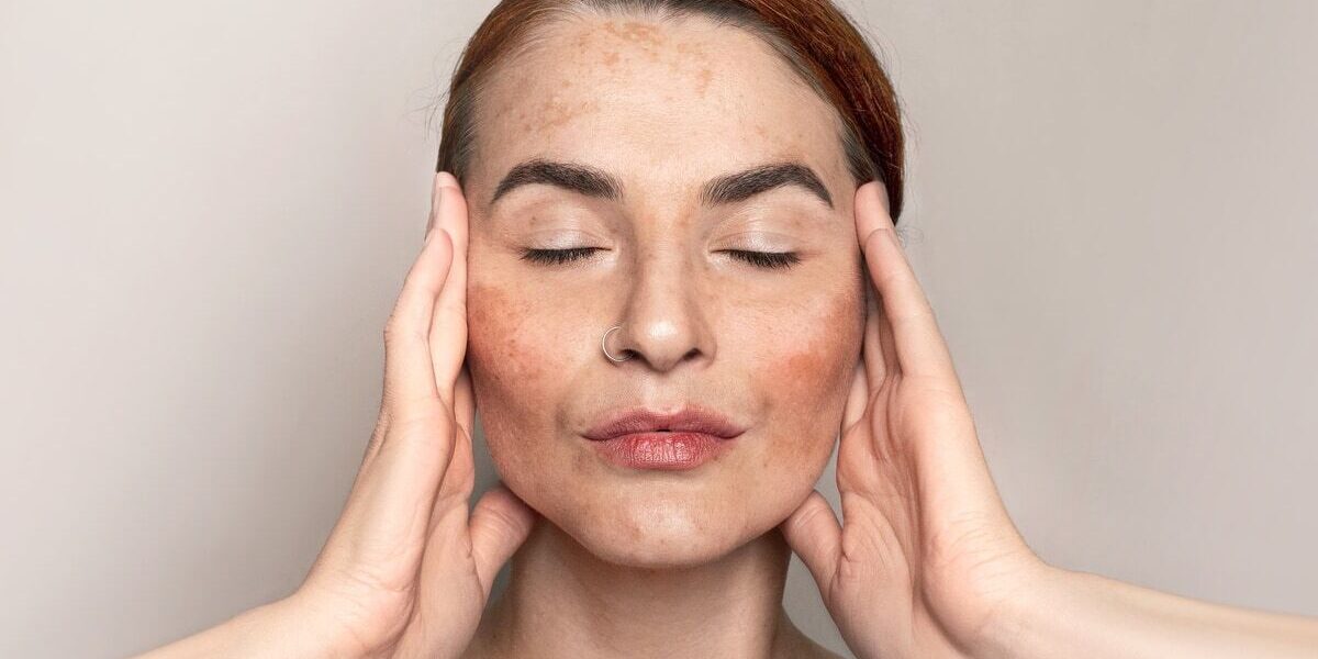 alcohol and melasma