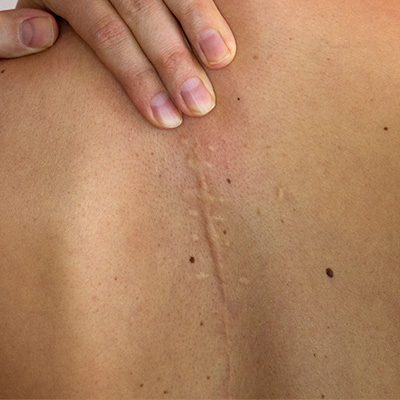 FFD 74158 TheDerm - ScarRevisions - New Image_v01