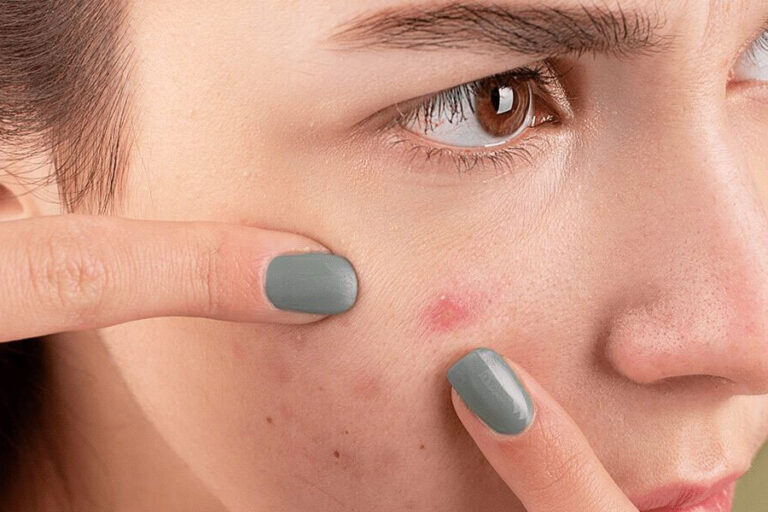 all-about-acne all about acne