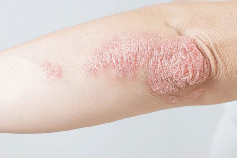 psoriasis psoriasis